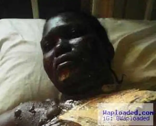 Neighbour scalds nursing mother with hot water during a dispute